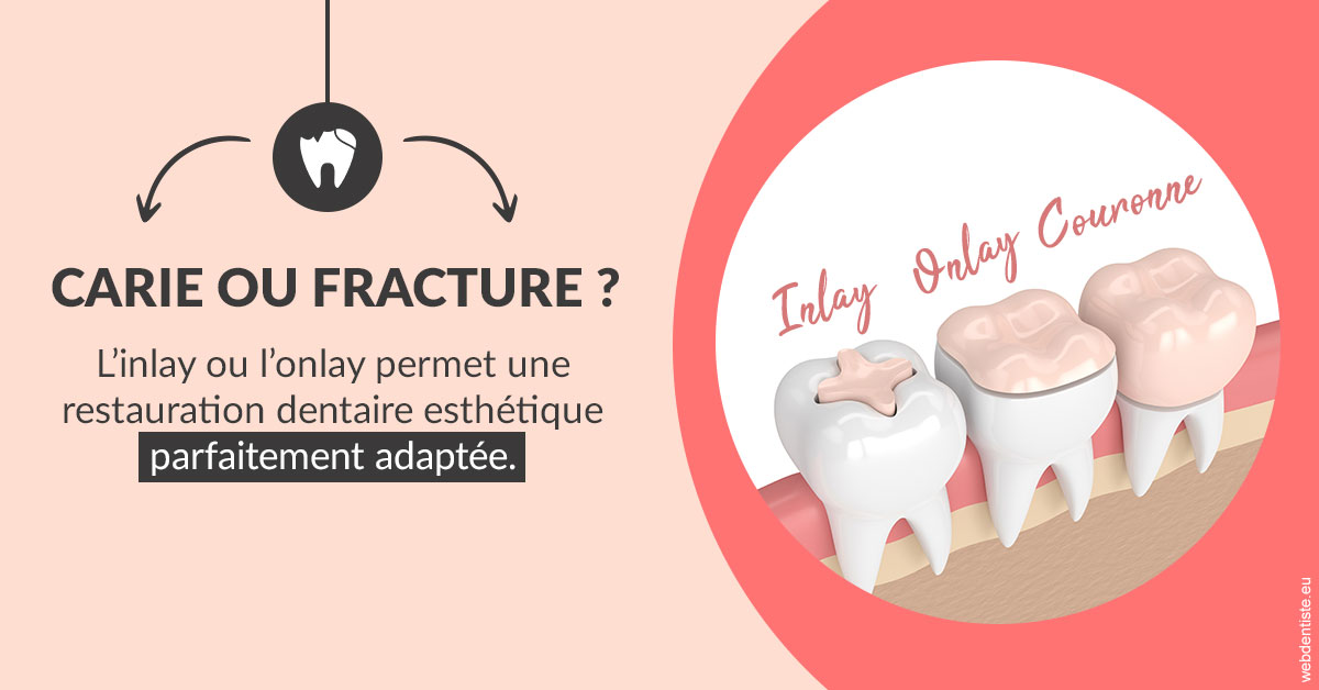 https://scp-peponnet-et-associes.chirurgiens-dentistes.fr/T2 2023 - Carie ou fracture 2
