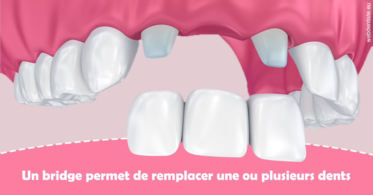 https://scp-peponnet-et-associes.chirurgiens-dentistes.fr/Bridge remplacer dents 2