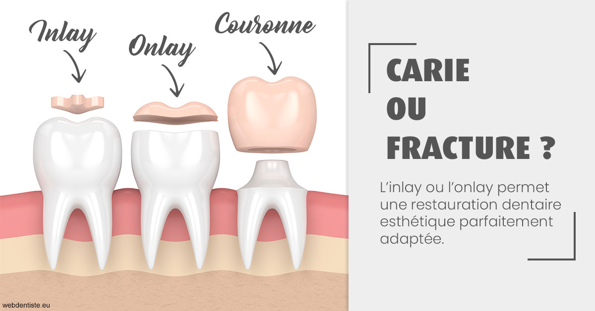 https://scp-peponnet-et-associes.chirurgiens-dentistes.fr/T2 2023 - Carie ou fracture 1
