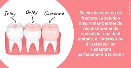 https://scp-peponnet-et-associes.chirurgiens-dentistes.fr/L'INLAY ou l'ONLAY 2
