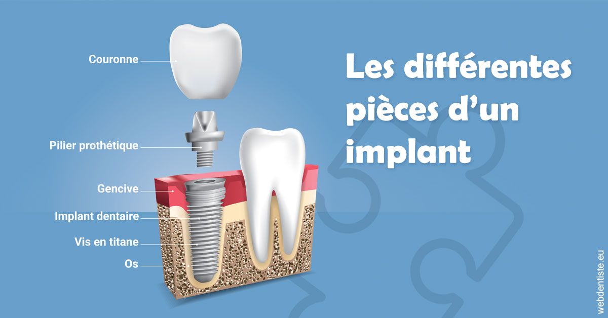 https://scp-peponnet-et-associes.chirurgiens-dentistes.fr/Les différentes pièces d’un implant 1
